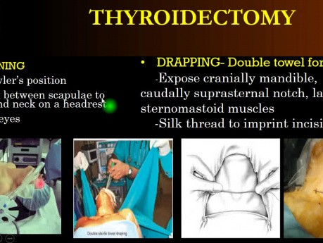 Tiroidectomía 