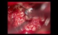 Neuroma acústico intra extrameatal