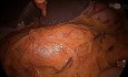 Colectomía derecha laparoscópica con control vascular CME