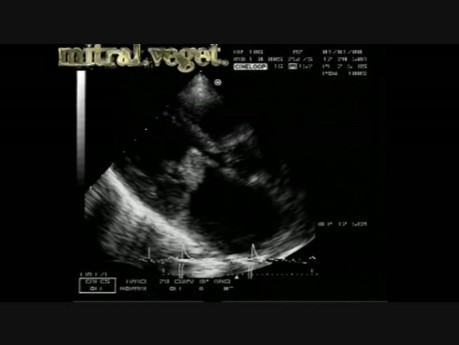 Endocarditis infecciosa: vegetación en ambas valvas mitrales con afectación de las cúspides aórticas