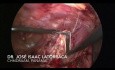 Resección Laparoscópica de Quiste Peritoneal Gigante 