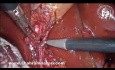 Esqueletización del conducto cístico y la arteria para hacer una visión crítica de seguridad
