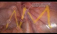 Etapas clave de las operaciones TAPP/TEP según el protocolo Critical View of Myopectineal Orifice