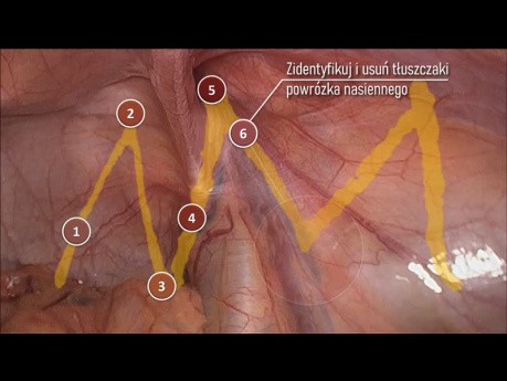 Etapas clave de las operaciones TAPP/TEP según el protocolo Critical View of Myopectineal Orifice