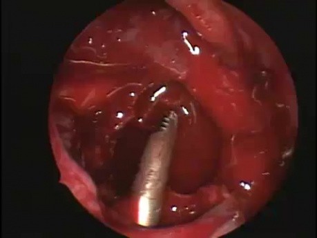 Intervención de Caldwell-Luc - endoscopia