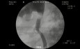 Acceso ureteral tras una lesión inducida quirúrgicamente.