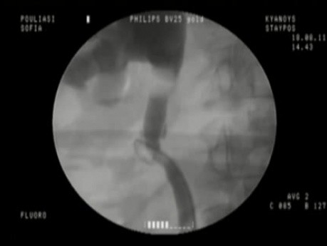 Acceso ureteral tras una lesión inducida quirúrgicamente.
