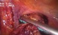 Resección de colon laparoscópica