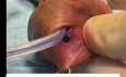 Distal Cavernous Urethral Perforation