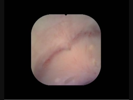 6.3F Uretroscopia flexible, sin editar (Parte 1)