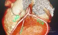 Angiografía coronaria por TC multicorte