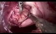 Miomectomía vNOTES - cirugía endoscópica transluminal a través de orificios naturales de para eliminar el fibroma