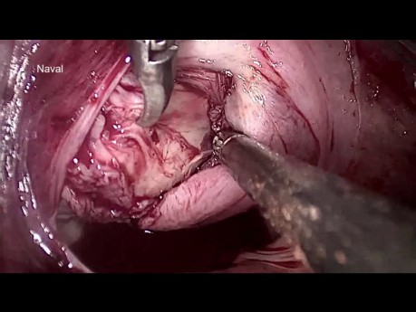 Miomectomía vNOTES - cirugía endoscópica transluminal a través de orificios naturales de para eliminar el fibroma