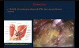Reparación laparoscópica con TEP de una gran hernia inguinal: destacando los puntos de referencia anatómicos