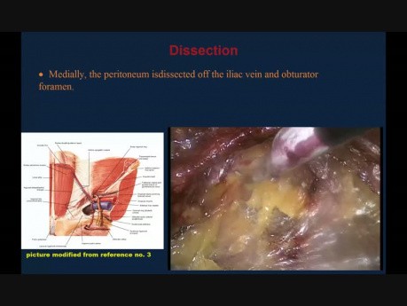Reparación laparoscópica con TEP de una gran hernia inguinal: destacando los puntos de referencia anatómicos