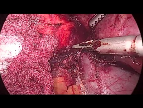 Adrenalectomía derecha laparoscópica para el carcinoma de corteza suprarrenal - procedimiento completo 