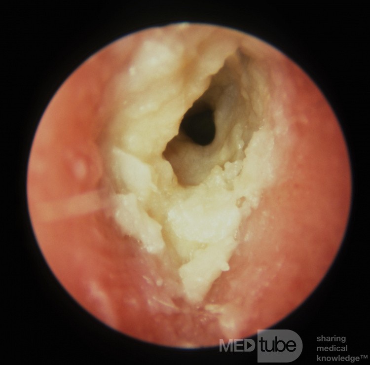 Otitis externa crónica Escamas de queratina
