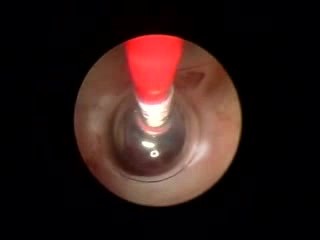 Tumor cerebral (quiste) visto en endoscopia.