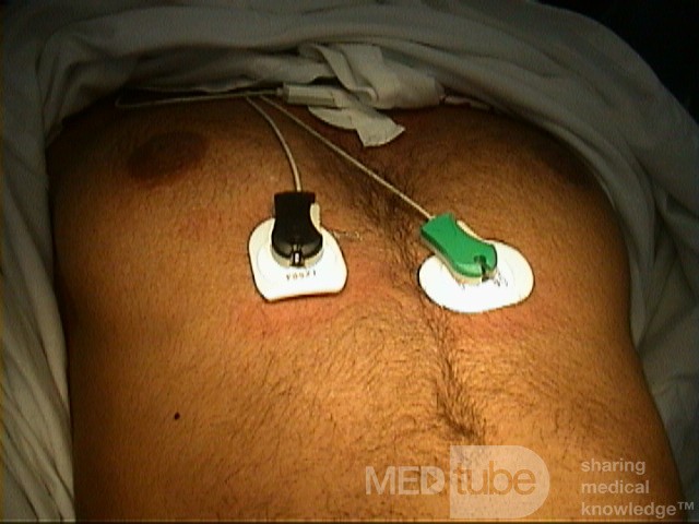 Tumor funcional de ovario, sin tejido glandular