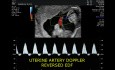 Doppler anormal en caso de RCIU