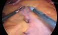 Bypass gástrico en Y de Roux con endohernia y uso de Seprafilm