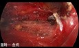 Cirugía endoscópica de tiroides transsubclavia de doble puerto (parte 1)