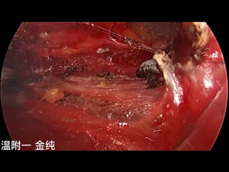 Cirugía endoscópica de tiroides transsubclavia de doble puerto (parte 1)