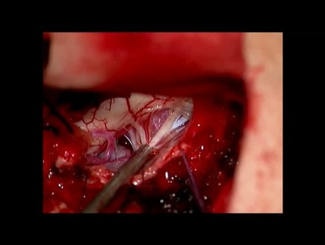 Meningioma en la columna cervical C1