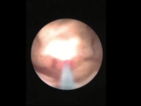 Litotricia extracorpórea por ondas de choque - Steinstrasse