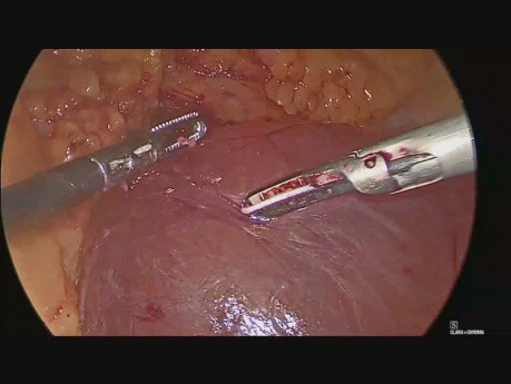Extirpación laparoscópica de un quiste mesotelial grande en el ángulo duodeno-yeyunal