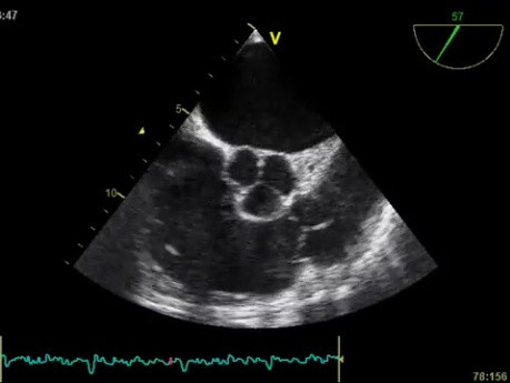 Ecocardiografía Transesofágica, Observación de la Válvula Pulmonar