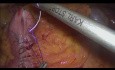 Ileotransversostomía intracorpórea s-t-s en hemicolectomía derecha laparoscópica con prueba de perfusión ICG