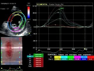 Acinesia antero-septal