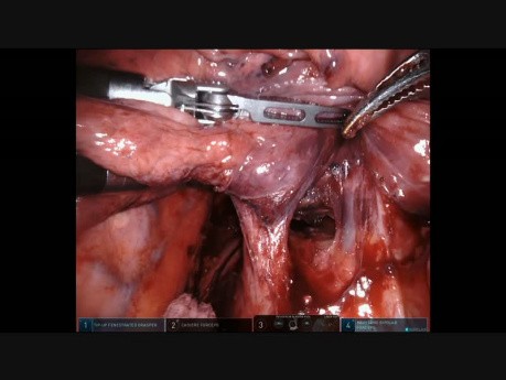 Cáncer de pulmón del lóbulo inferior - neumonectomía robótica