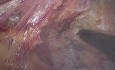 Escisión mesorrectal total laparoscópica (TME) + Anastomosis colorrectal ultrabaja