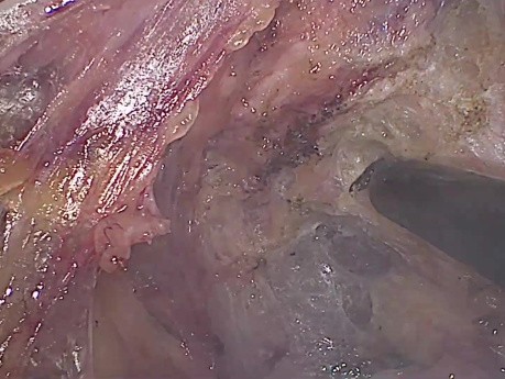 Escisión mesorrectal total laparoscópica (TME) + Anastomosis colorrectal ultrabaja