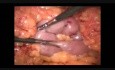 Bypass gástrico laparoscópico