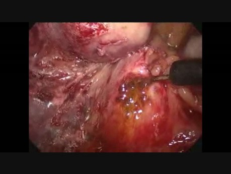 Exploración laparoscópica del conducto biliar común después de la colecistectomía.