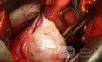 Arrenoblastoma 