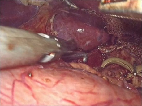 Cirugía laparoscópica para el síndrome del ligamento mediano arcuato