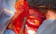 Descompresión cardíaca completa durante el trasplante pulmonar bilateral