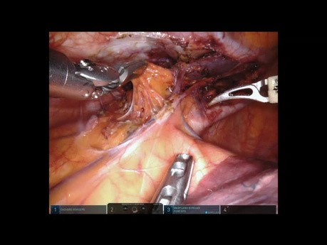 Tumor del mediastino anterior - tiroides ectópica