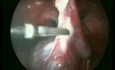 Cirugía de quiste ovárico - método laparoscópico