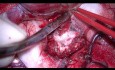 Glioma insular derecho. Resección de Transilviana