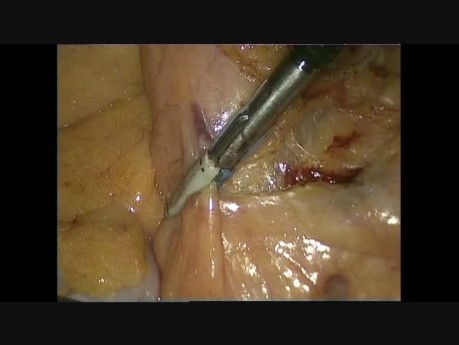 Disección laparoscópica y exposición de la arteria mesentérica inferior en cirugía colorrectal para el cáncer