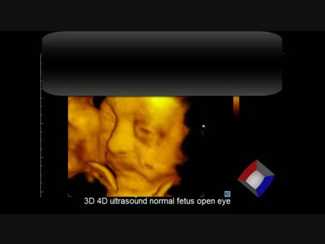 Ultrasonido 3D 4D de feto normal, ojo abierto