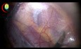Anatomía laparoscópica de la hernia inguinal