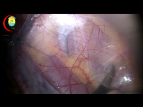 Anatomía laparoscópica de la hernia inguinal