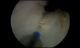 Enucleación prostática con láser de holmio (HoLEP) con incisión de absceso prostático