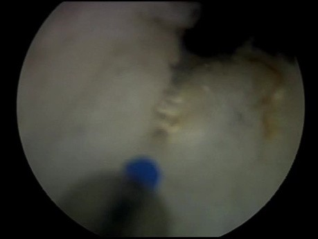 Enucleación prostática con láser de holmio (HoLEP) con incisión de absceso prostático